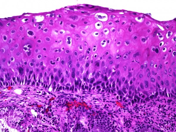 cervix flatcondyloma2