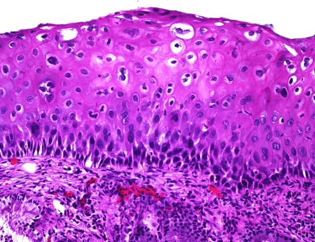 cervix flatcondyloma2