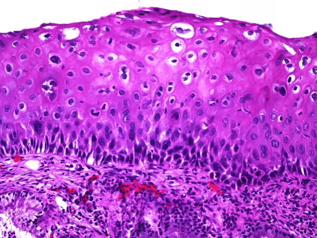 Hpv genitális szemölcsök Genitális szemölcsök (nemi szervi szemölcsök) - EgészségKalauz