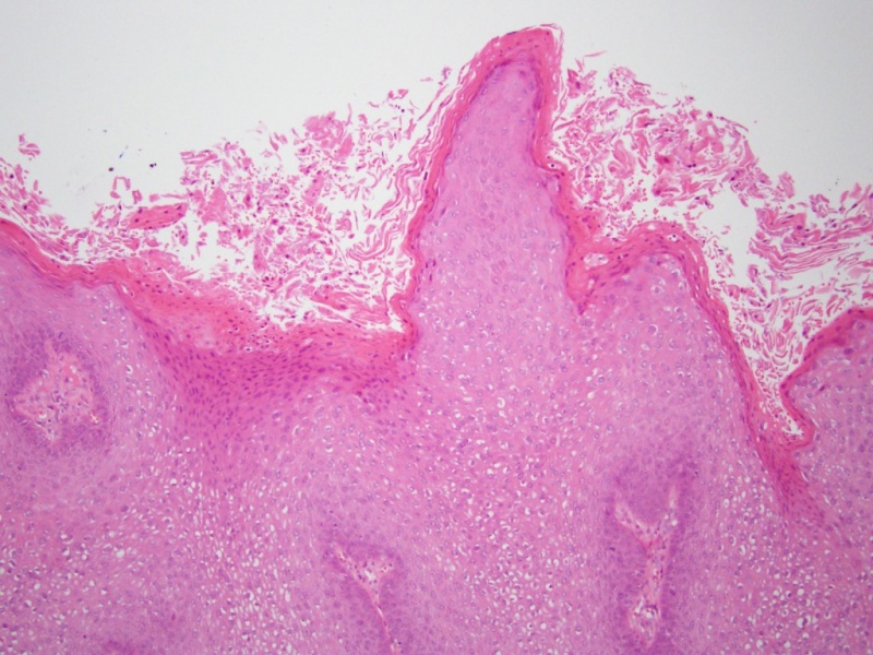 A HPV-fertőzés tünetei nőkben és férfiakban