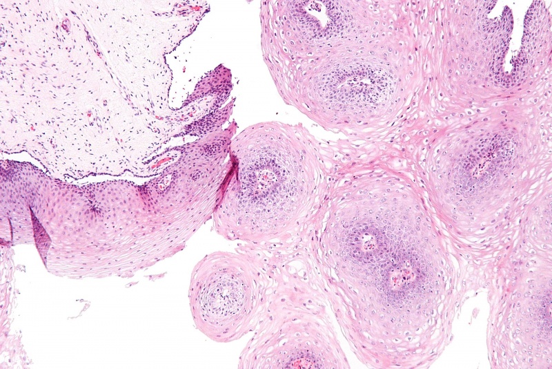 A HPV-fertőzés tünetei nőkben és férfiakban - Hogyan nőnek a szemölcsök és a papillómák