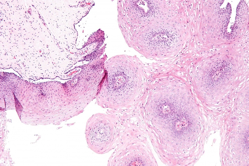 Condyloma cauterization